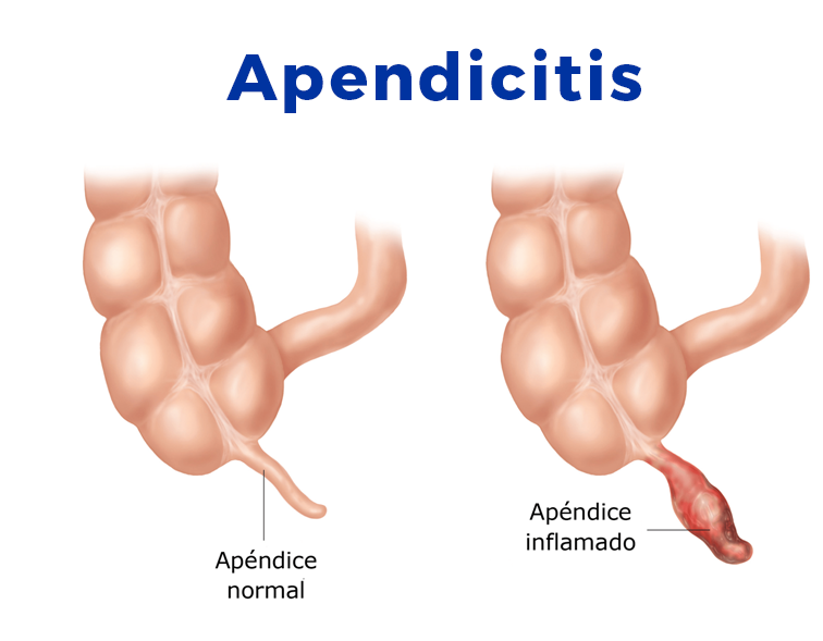 ilustración de apendicitis